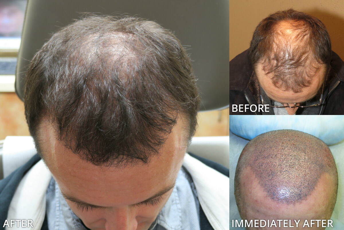 FUE Hair Transplantation – Before and After Pictures