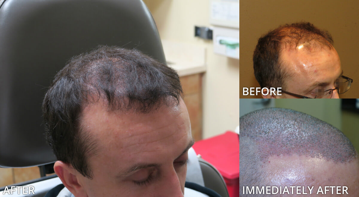 FUE Hair Transplantation – Before and After Pictures