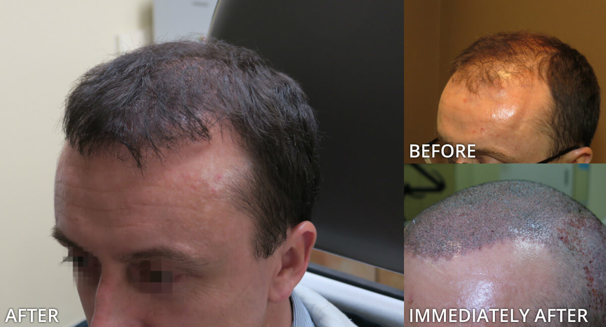 FUE Hair Transplantation – Before and After Pictures