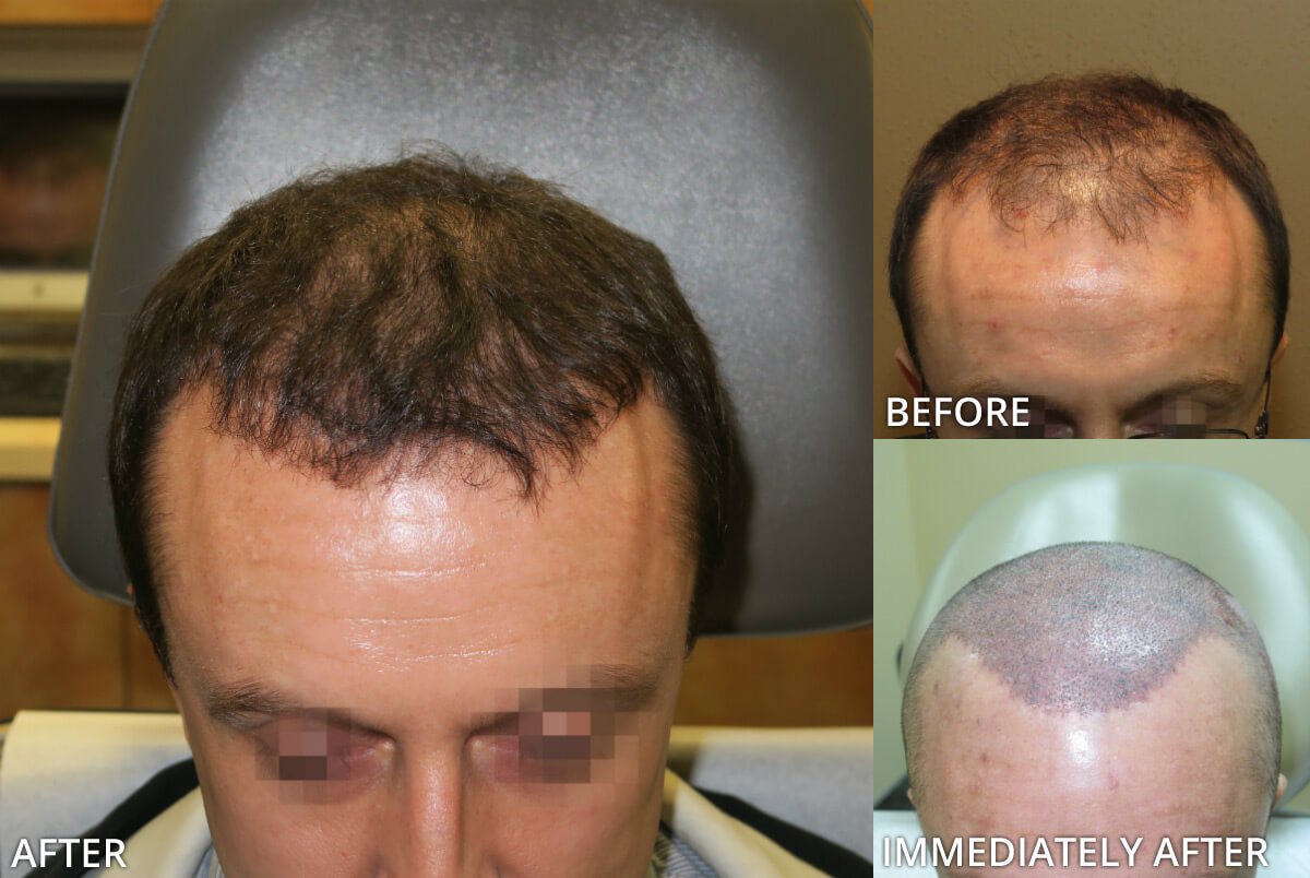 FUE Hair Transplantation – Before and After Pictures