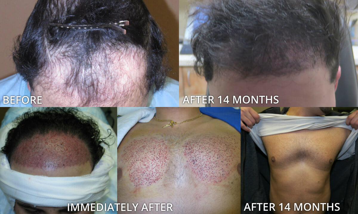 FUE Hair Transplantation – Before and After Pictures