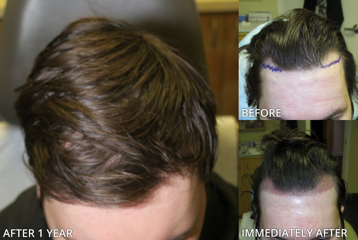 FUE Hair Transplantation – Before and After Pictures