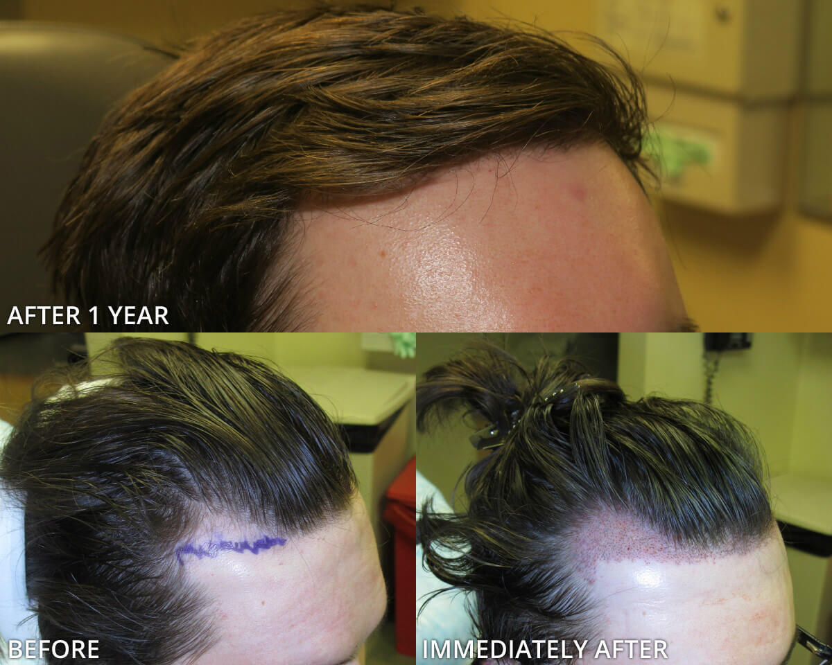 FUE Hair Transplantation – Before and After Pictures