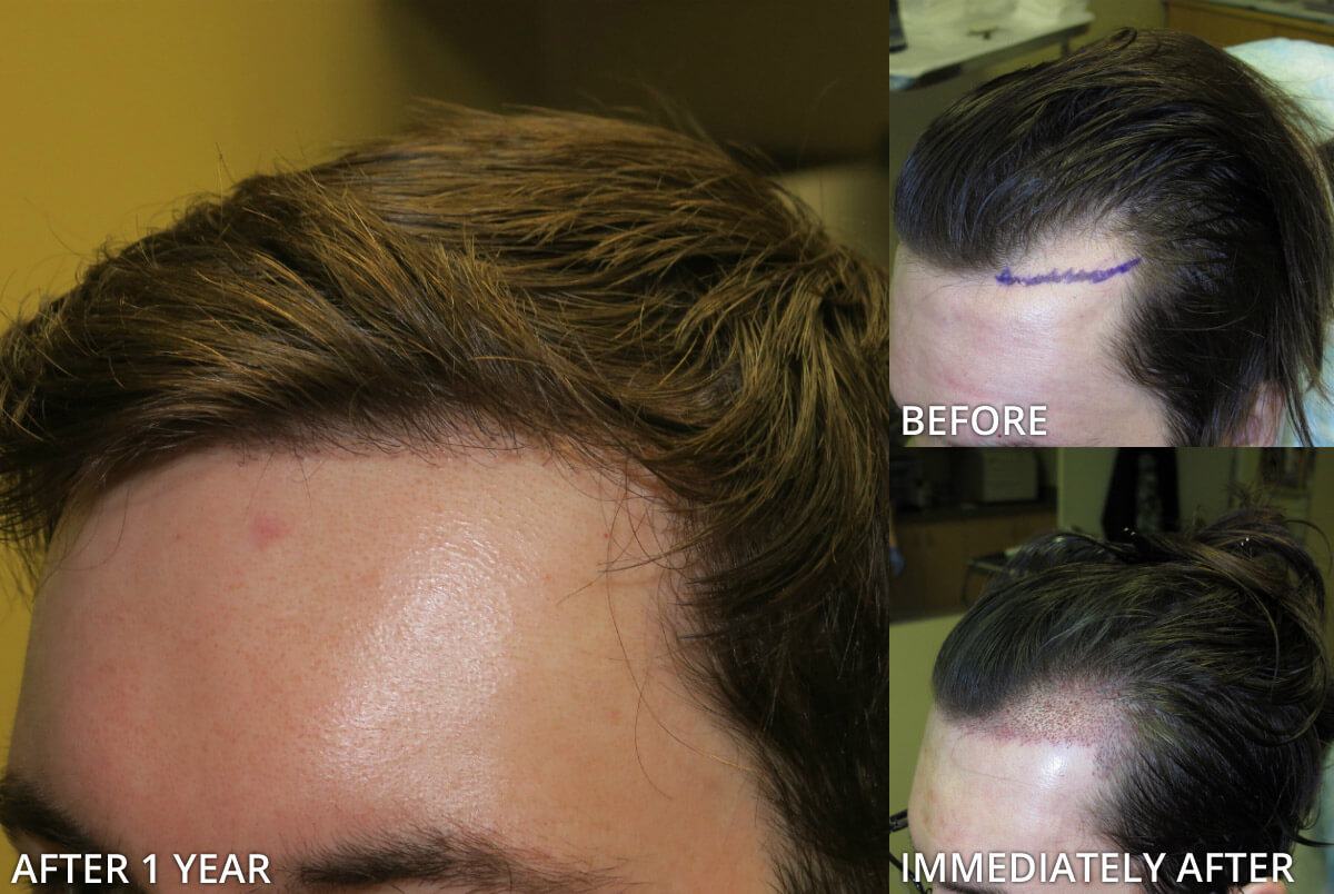 FUE Hair Transplantation – Before and After Pictures