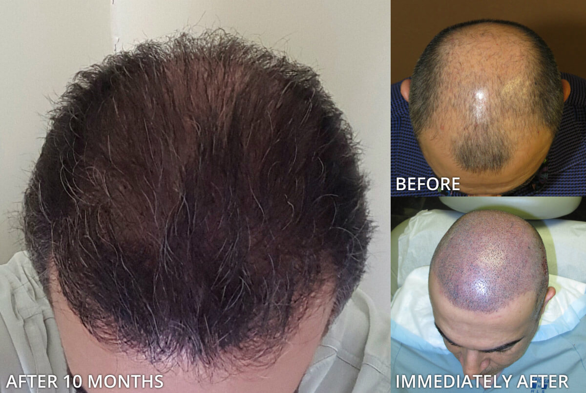 FUE Hair Transplantation – Before and After Pictures