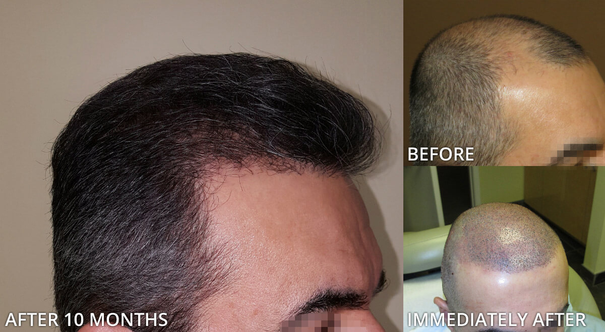 FUE Hair Transplantation – Before and After Pictures