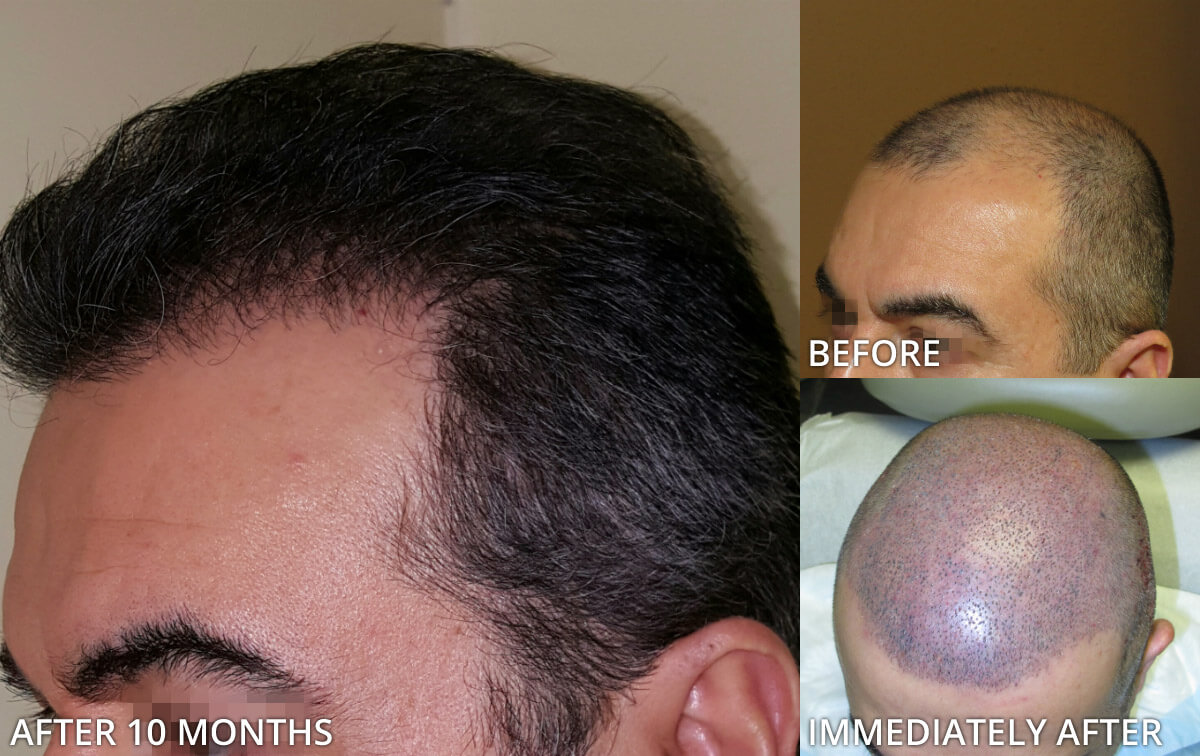 FUE Hair Transplantation – Before and After Pictures