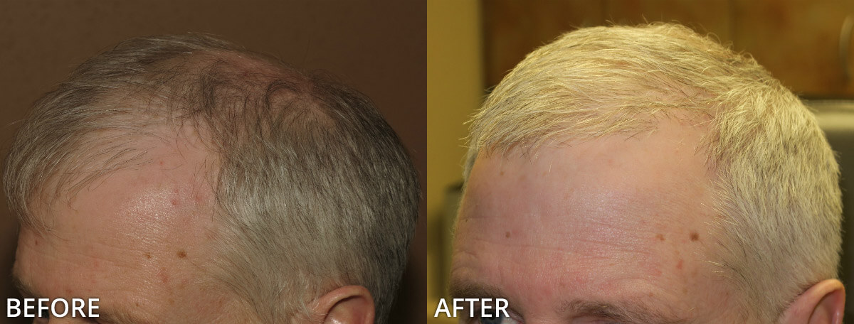 FUE Hair Transplantation – Before and After Pictures