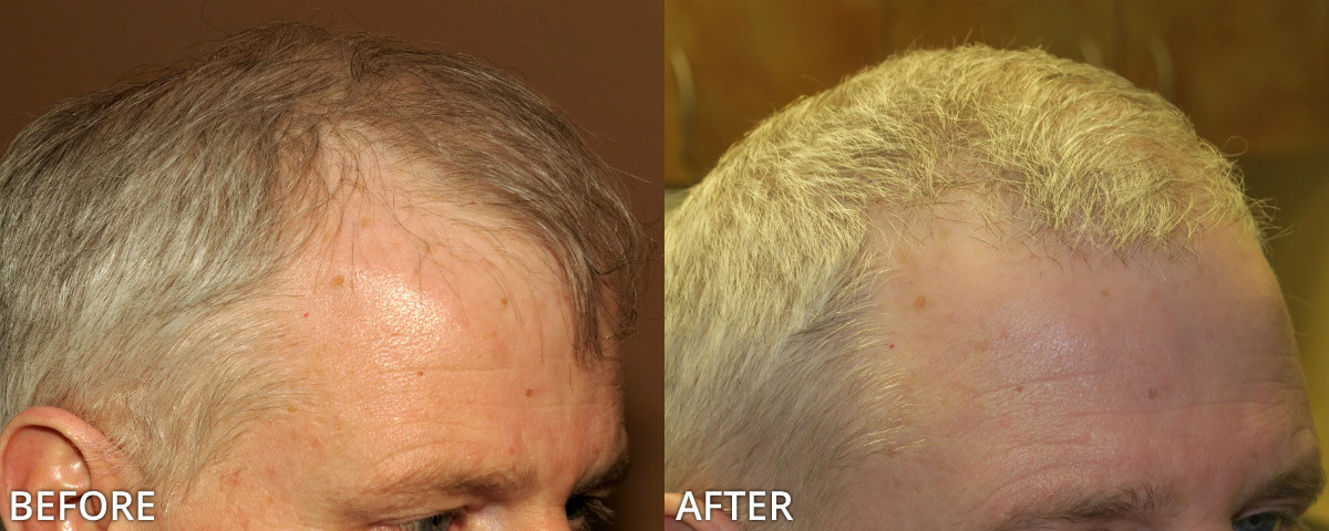 FUE Hair Transplantation – Before and After Pictures