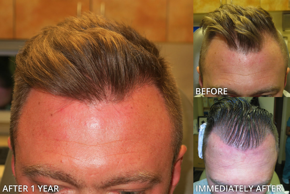 FUE Hair Transplantation – Before and After Pictures