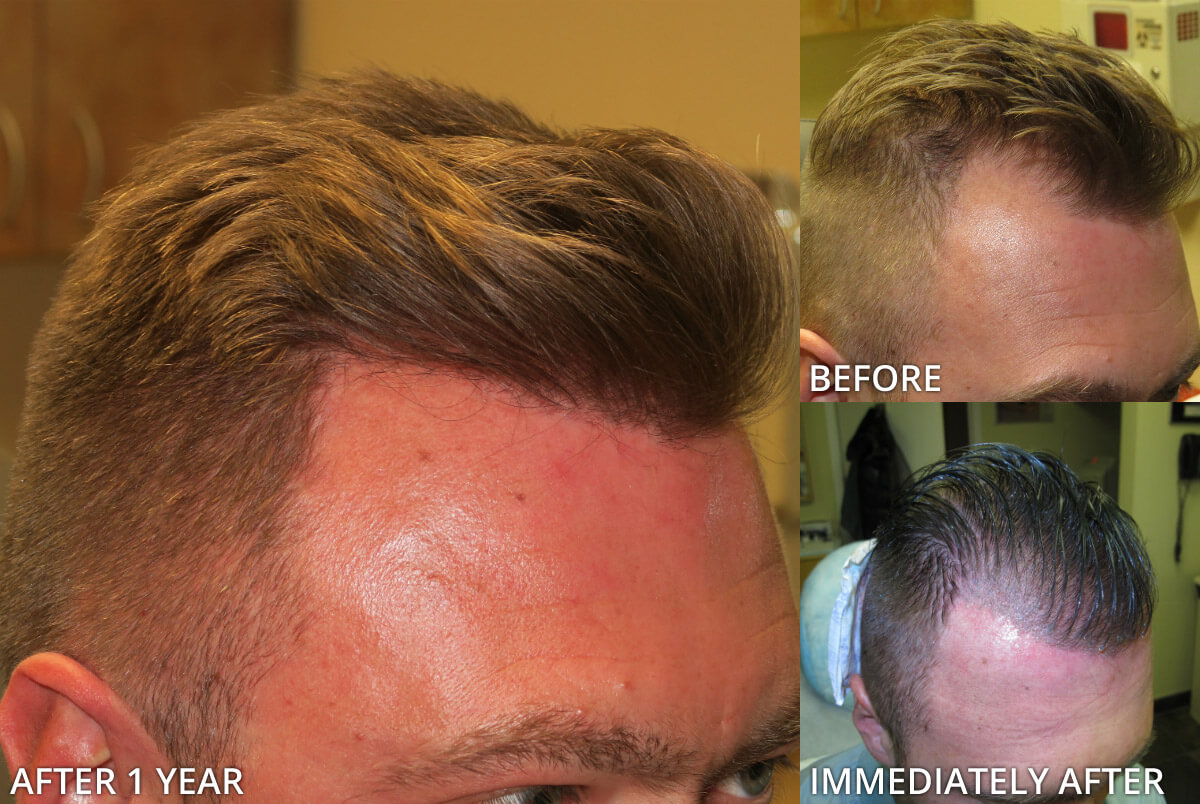 FUE Hair Transplantation – Before and After Pictures