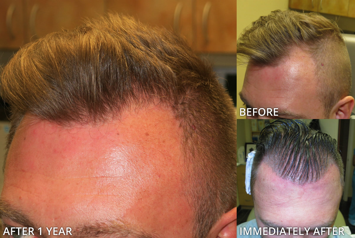 FUE Hair Transplantation – Before and After Pictures