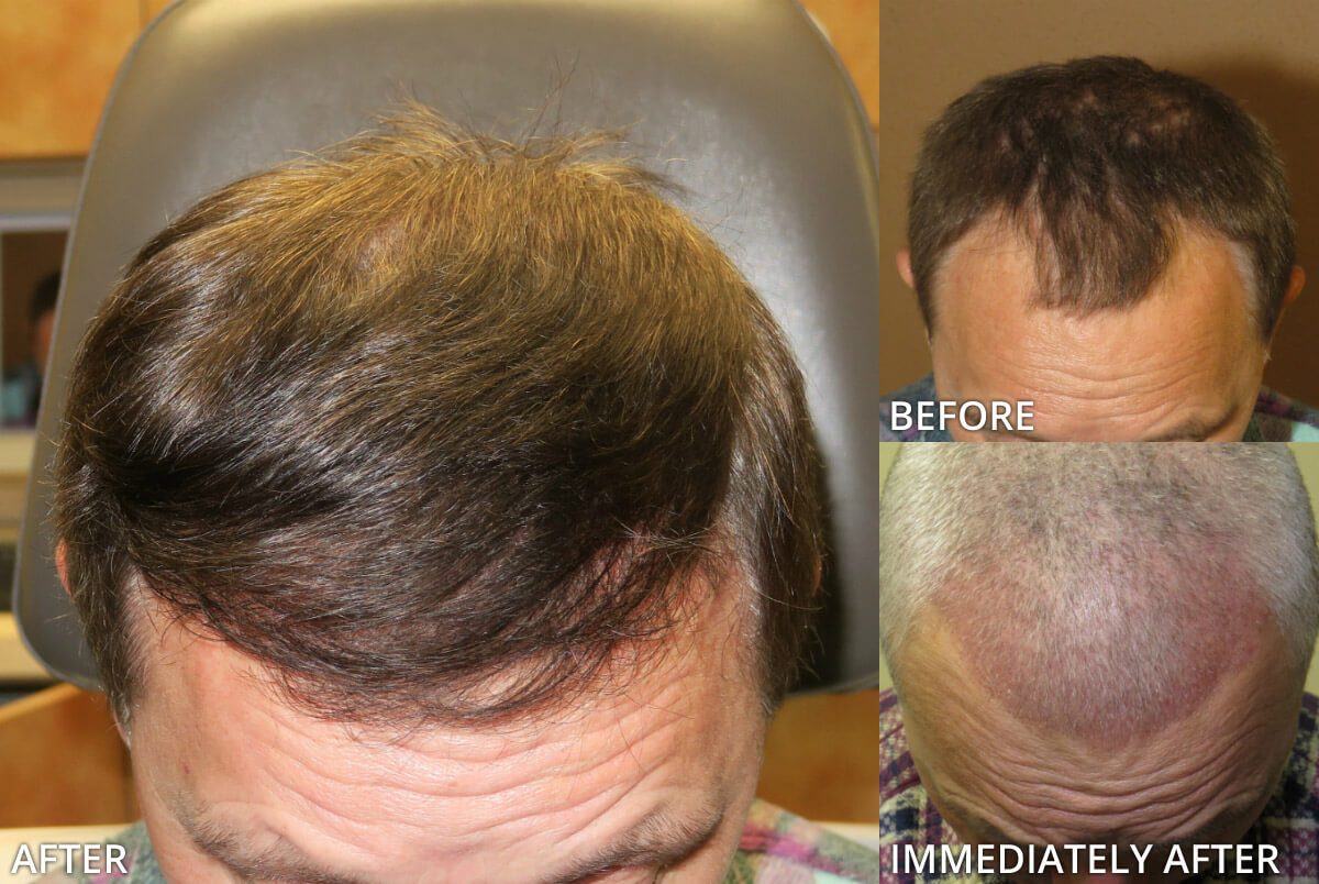 FUE Hair Transplantation – Before and After Pictures