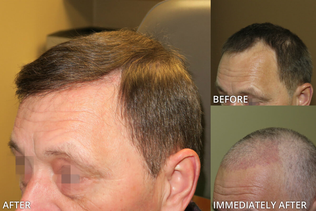 FUE Hair Transplantation – Before and After Pictures