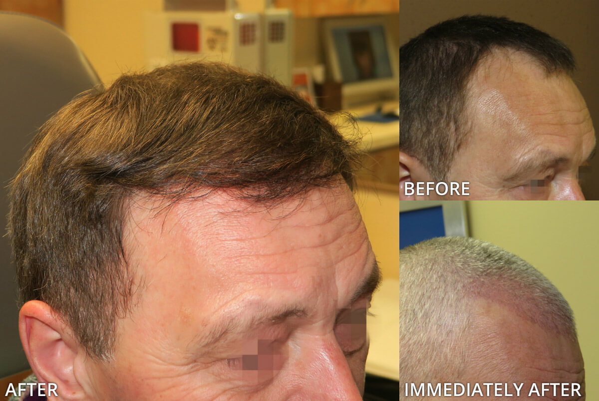 FUE Hair Transplantation – Before and After Pictures