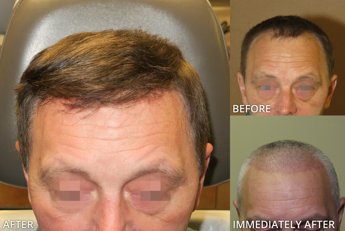 FUE Hair Transplantation – Before and After Pictures