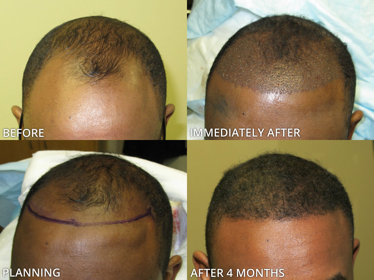 FUE Hair Transplantation – Before and After Pictures