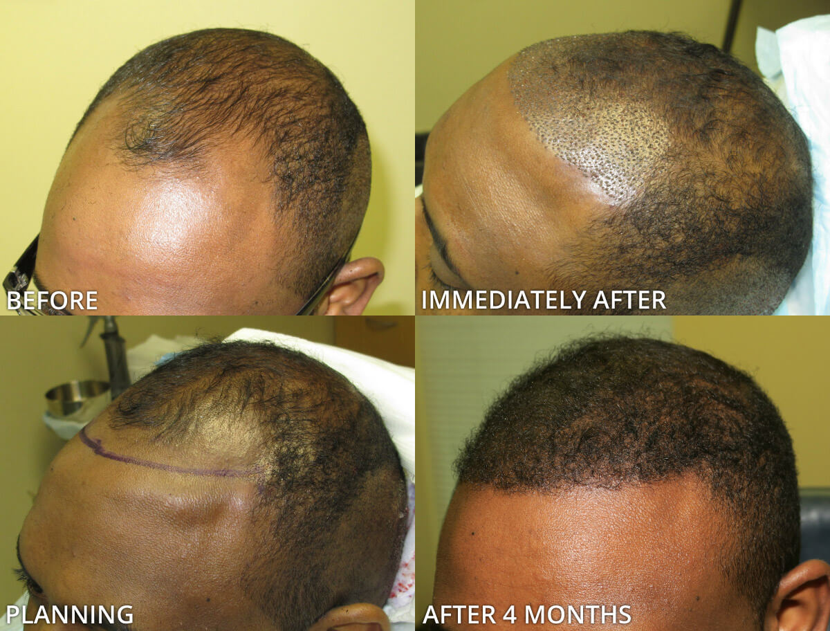 FUE Hair Transplantation – Before and After Pictures