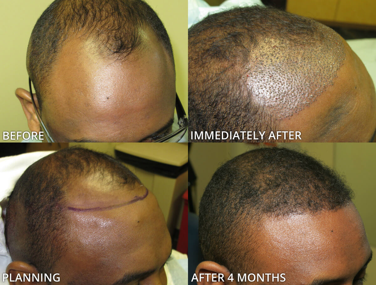 FUE Hair Transplantation – Before and After Pictures