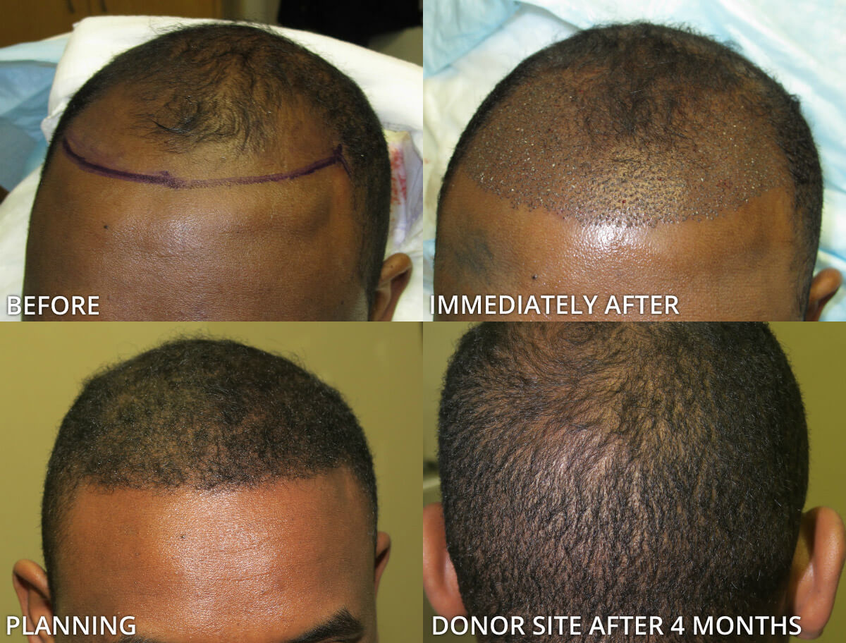 FUE Hair Transplantation – Before and After Pictures