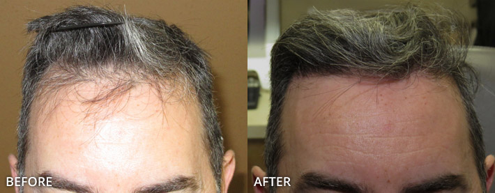 FUE Hair Transplantation – Before and After Pictures