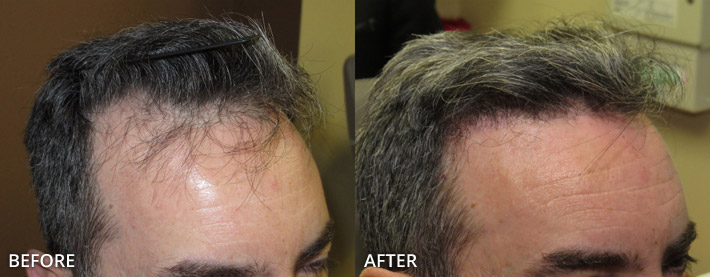 FUE Hair Transplantation – Before and After Pictures