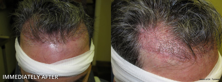 FUE Hair Transplantation – Before and After Pictures