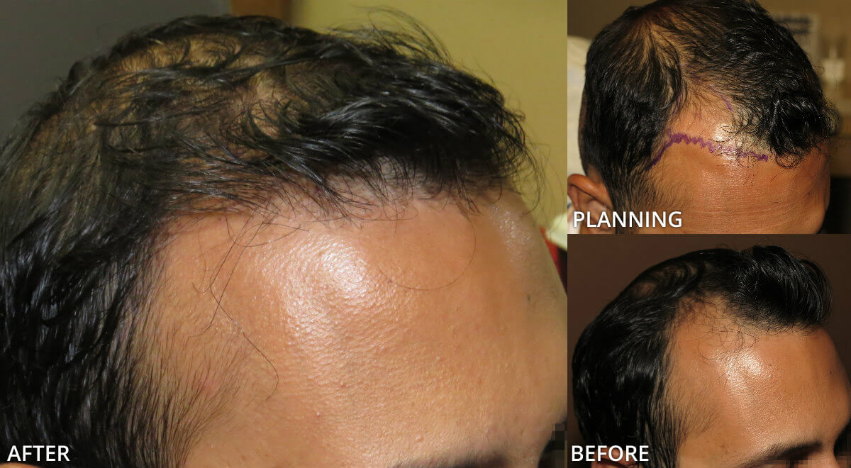 FUE Hair Transplantation – Before and After Pictures