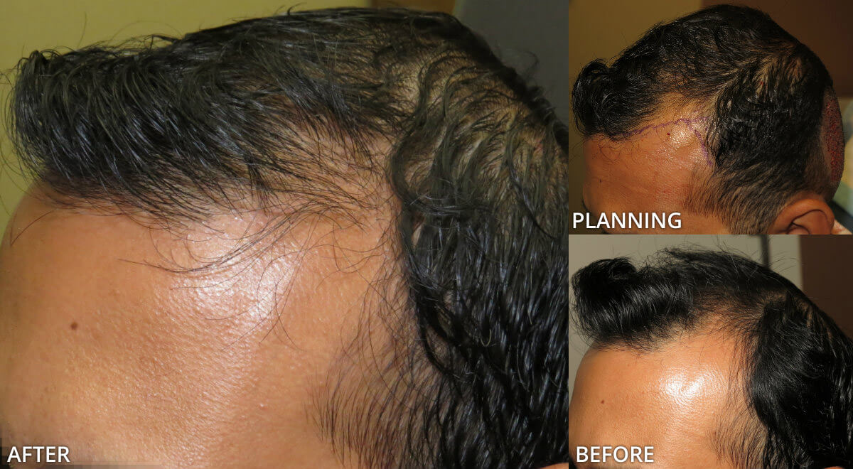 FUE Hair Transplantation – Before and After Pictures