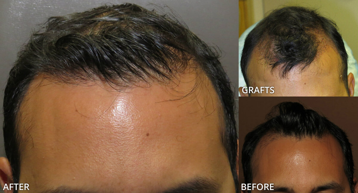 FUE Hair Transplantation – Before and After Pictures