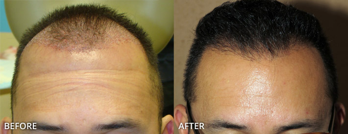 FUE Hair Transplantation – Before and After Pictures