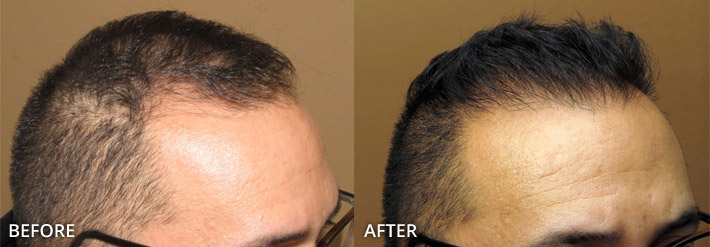 FUE Hair Transplantation – Before and After Pictures