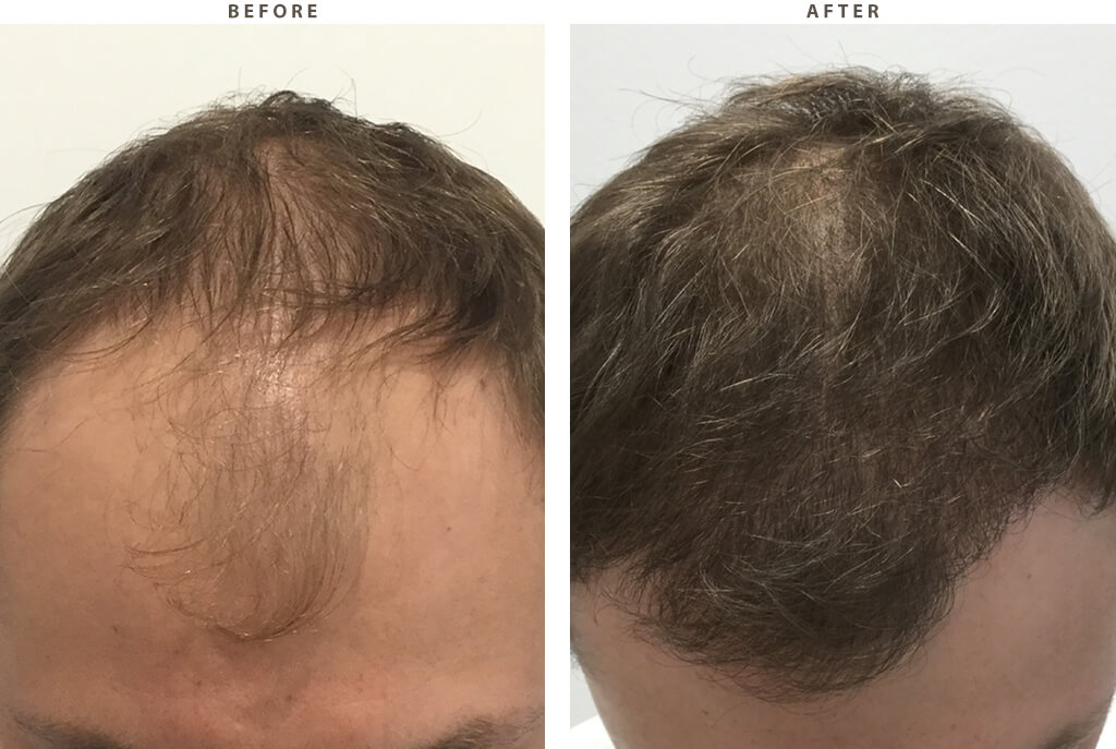 Hair Transplant - Before and After Pictures