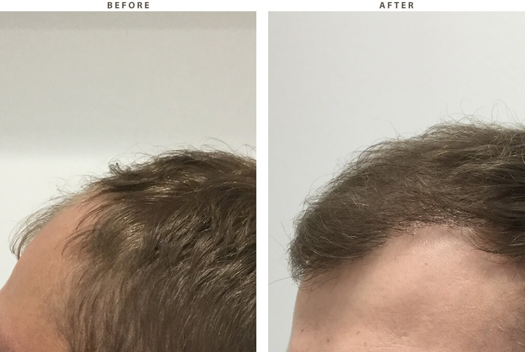 Hair Transplant - Before and After Pictures