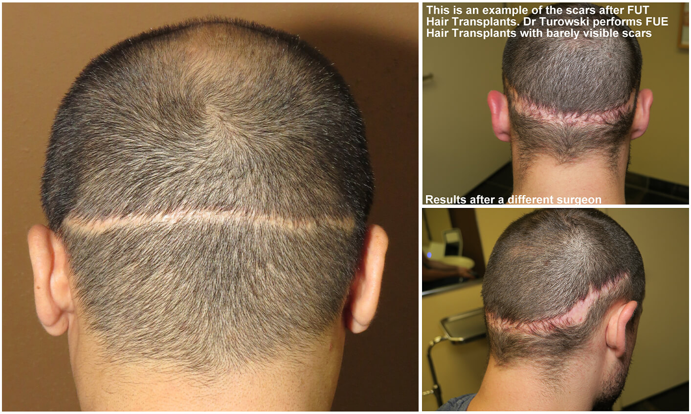 Hair Transplantation - Before and After Pictures