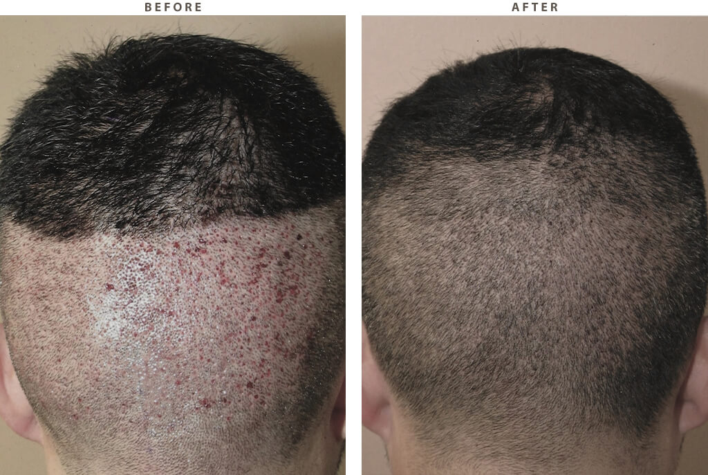 Hair Transplantation - Before and After Pictures