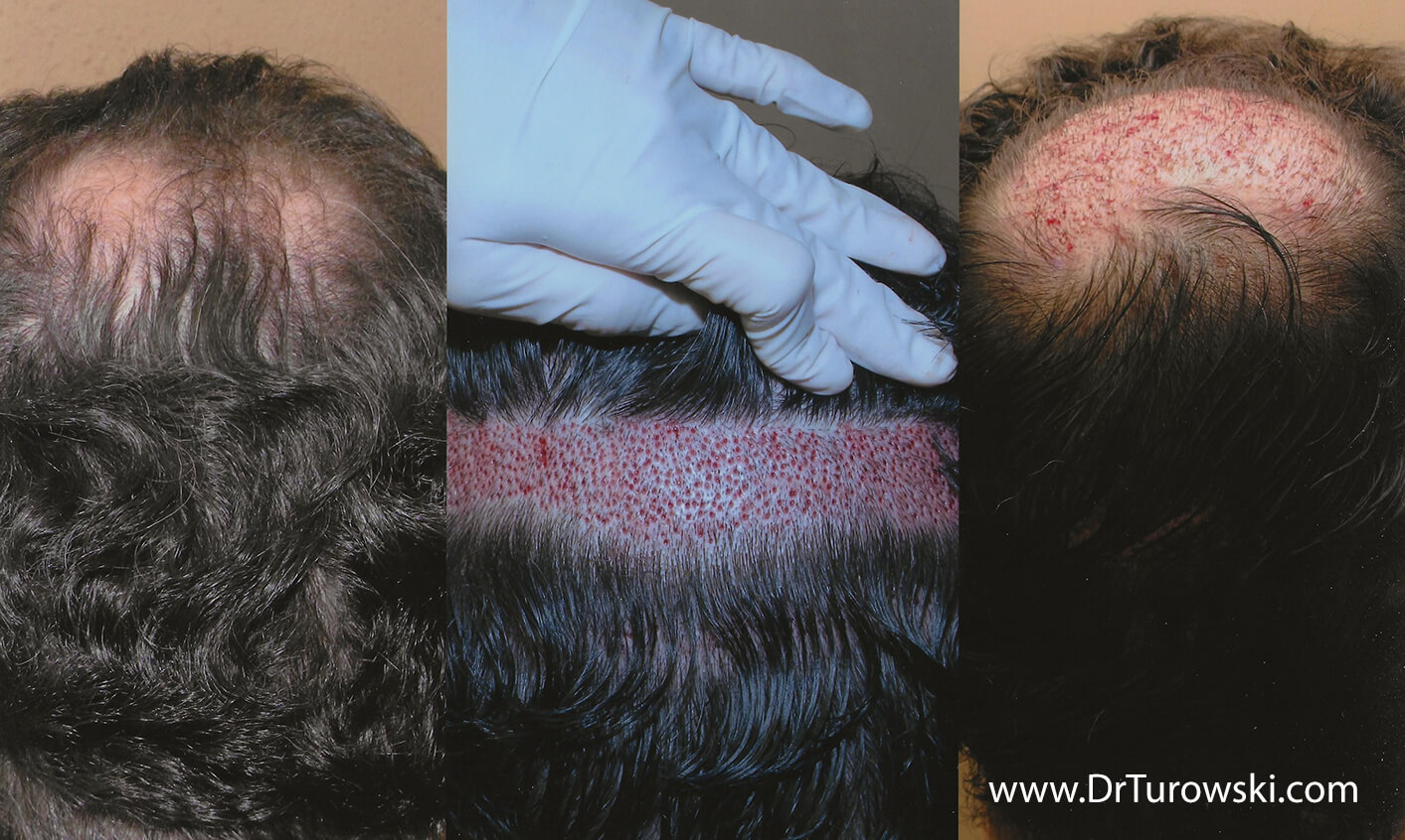 Hair Transplantation - Before and After Pictures