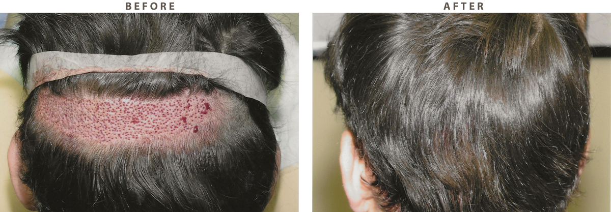 Hair Transplantation - Before and After Pictures