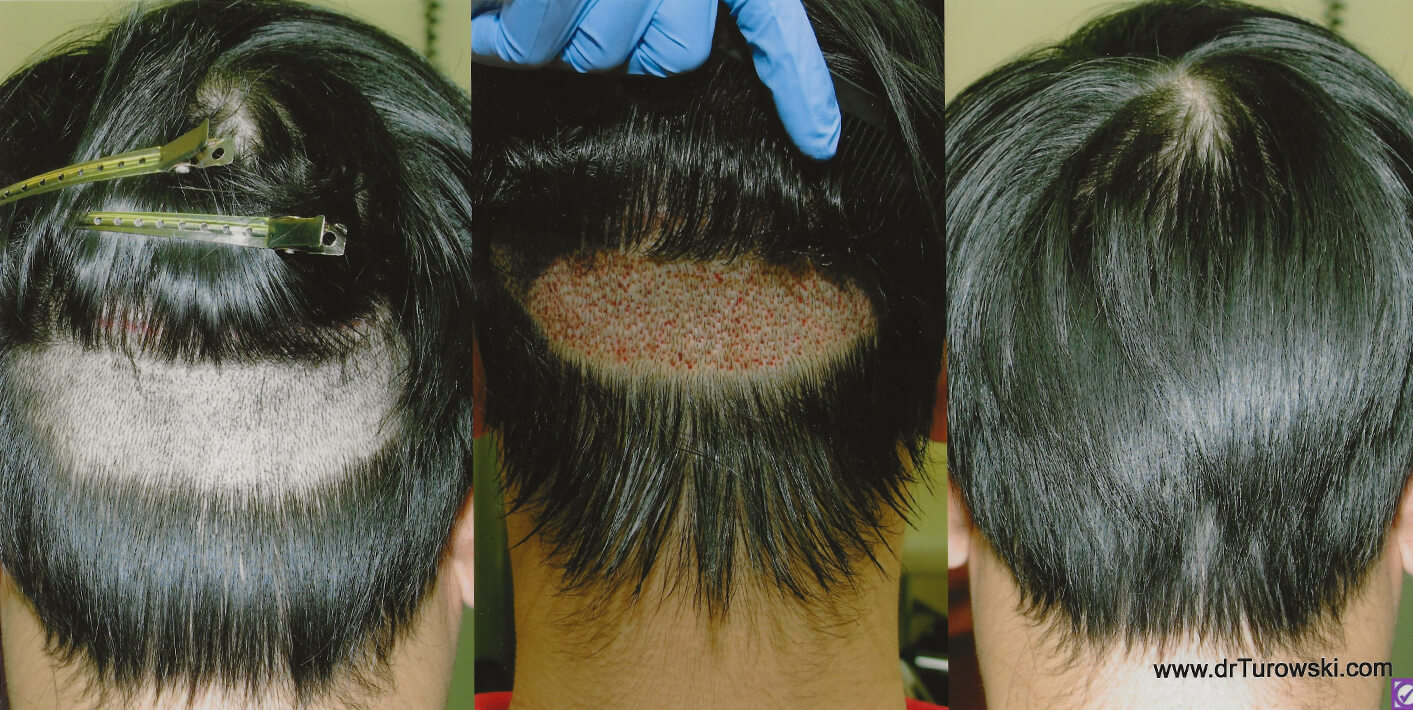 Hair Transplantation - Before and After Pictures