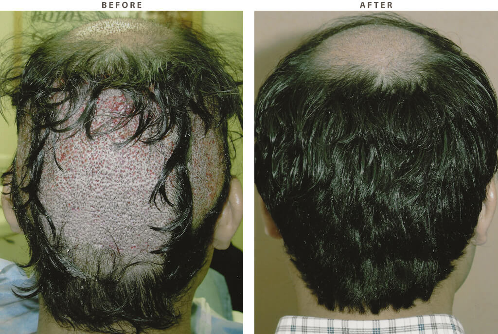 Hair Transplantation - Before and After Pictures