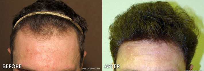 FUE Hair Transplantation – Before and After Pictures