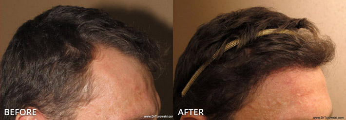 FUE Hair Transplantation – Before and After Pictures