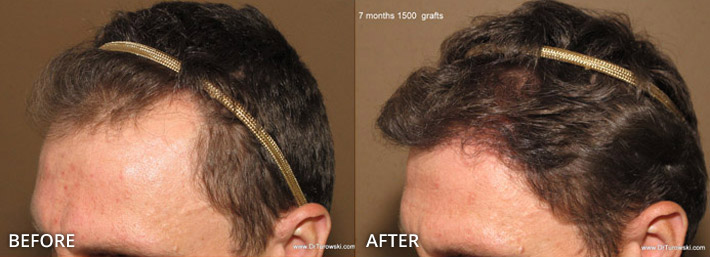 FUE Hair Transplantation – Before and After Pictures