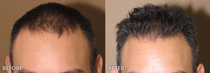 FUE Hair Transplantation – Before and After Pictures