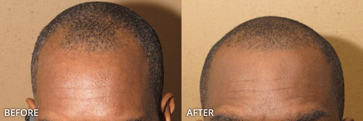 FUE Hair Transplantation – Before and After Pictures