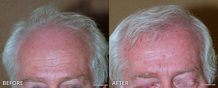 FUE Hair Transplantation – Before and After Pictures