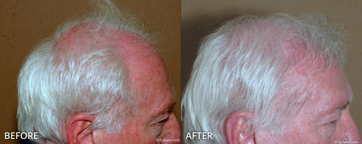 FUE Hair Transplantation – Before and After Pictures