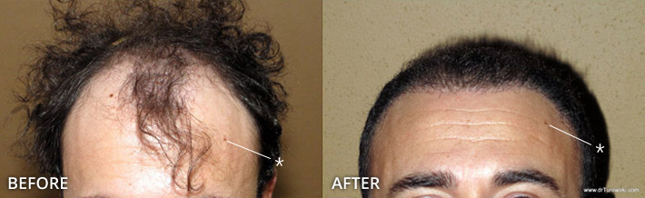 FUE Hair Transplantation – Before and After Pictures