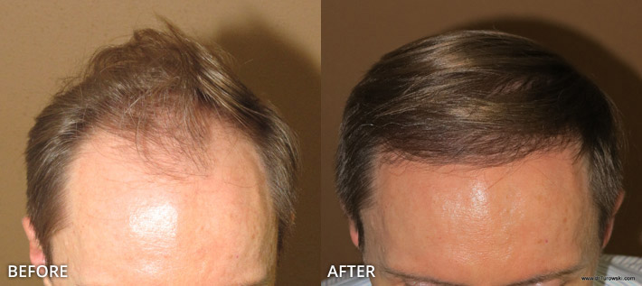 FUE Hair Transplantation – Before and After Pictures