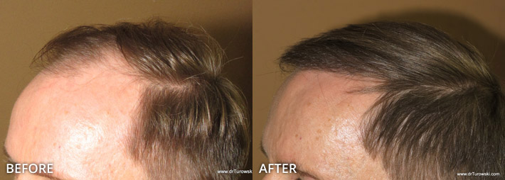 FUE Hair Transplantation – Before and After Pictures